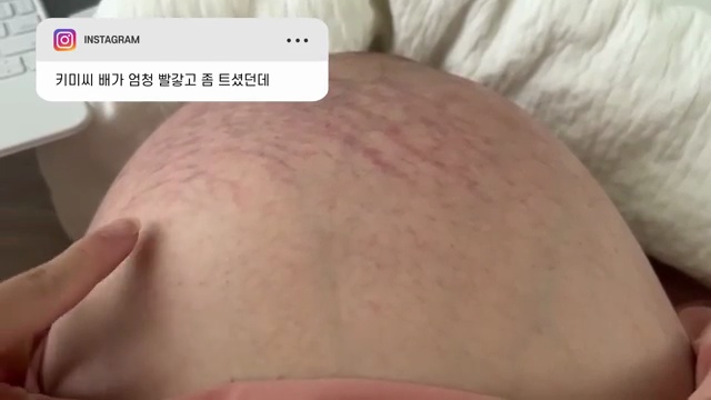 쌍둥이 임신 막달의 기적과 도전: 배는 어디까지 커질까?